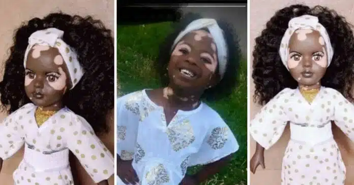 bonecas-com-vitiligo-ajudam-criancas-com-mesma-condicao-a-gostarem-de-si-mesmas Bonecas com vitiligo ajudam crianças com mesma condição a gostarem de si mesmas