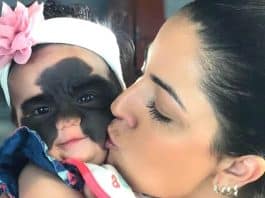 Menina com marca de nascença ‘batman’ diz “Eu sou uma princesa” após cirurgias de remoção