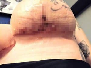 sabiaspalavras.com - Paciente foi reduzir os seios e acordou com implantes mamários e lipo por engano