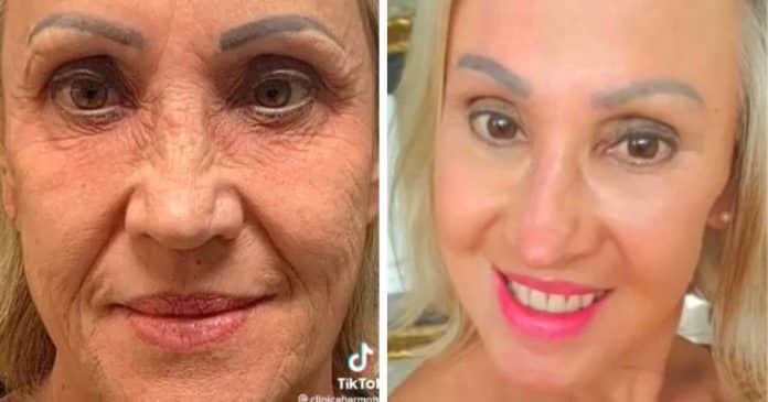 Mulher surpreende após tratamento estético que parece “trocar de rosto”: ‘30 anos mais jovem’