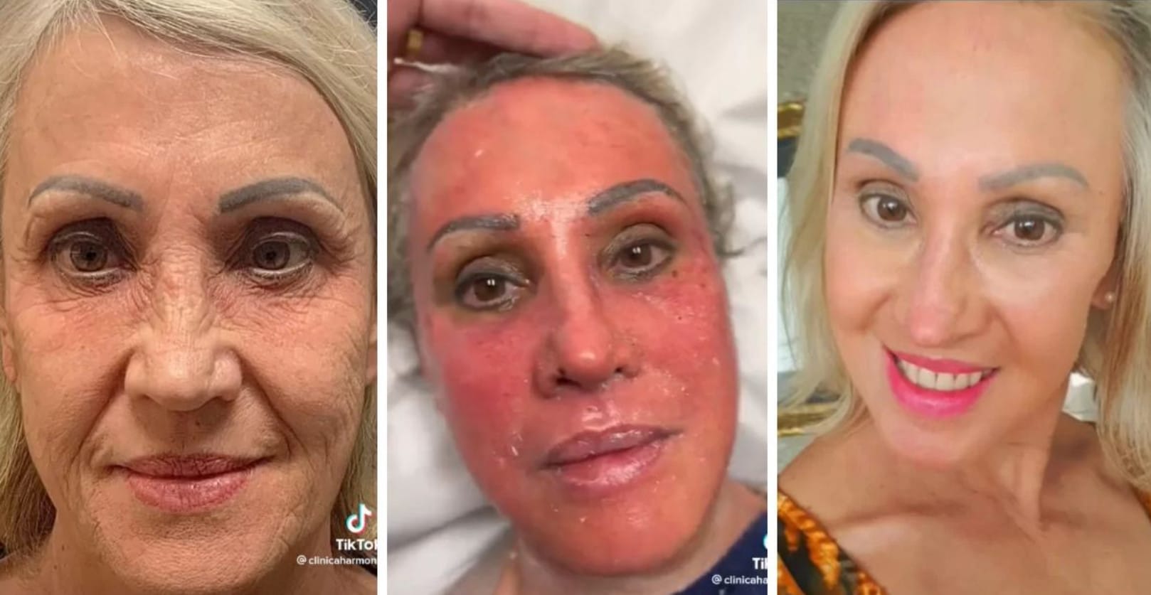 sabiaspalavras.com - Mulher surpreende após tratamento estético que parece "trocar de rosto": ‘30 anos mais jovem’