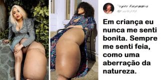 Aspirante a modelo com perna de 45 Kg abraça a sua singularidade