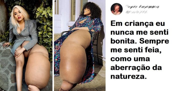 Aspirante a modelo com perna de 45 Kg abraça a sua singularidade