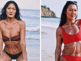 Modelo de 31 anos com condição rara de pele, cuja autoaceitação das suas rugas é um exemplo