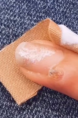 sabiaspalavras.com - Mulher desenvolve câncer de pele após corte de manicure em salão de beleza