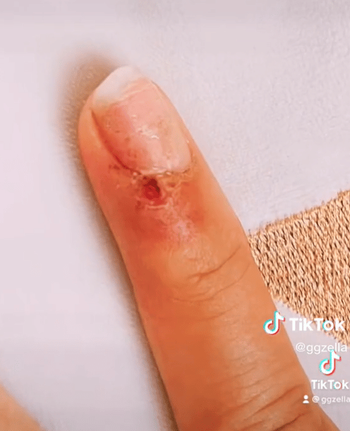 sabiaspalavras.com - Mulher desenvolve câncer de pele após corte de manicure em salão de beleza