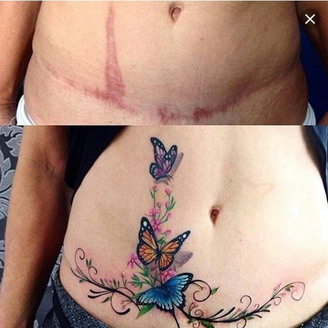sabiaspalavras.com - 13 tatuagens que transformaram cicatrizes e marcas de nascença em obras de arte