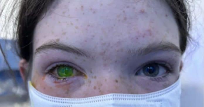 Doença rara que deixa o olho verde causa preocupação entre médicos na Austrália