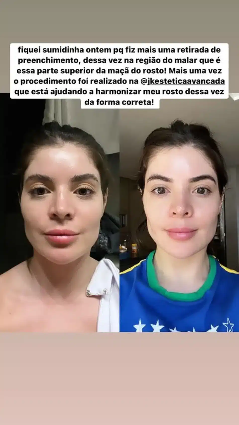 sabiaspalavras.com - Gkay está em "desarmonização facial" e mostra antes e depois dos excessos de procedimentos