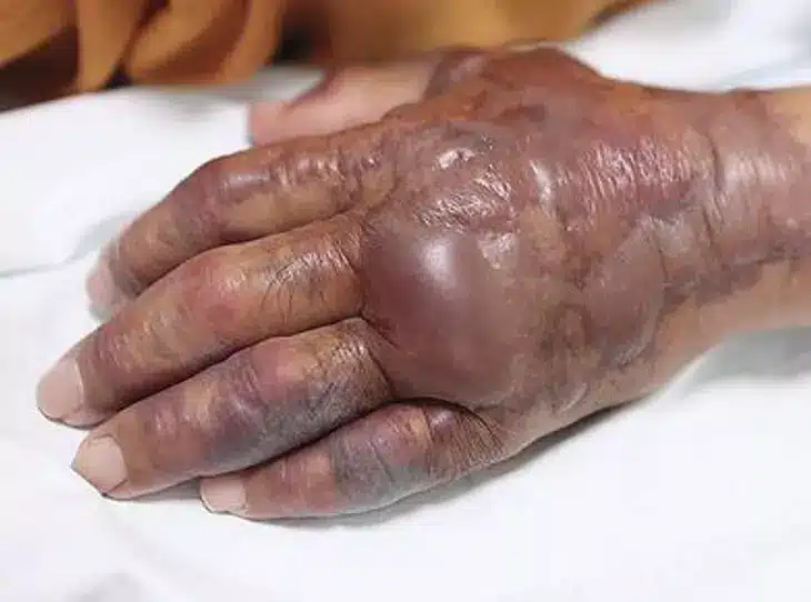 sabiaspalavras.com - Homem de 71 anos teve braço amputado após comer sushi
