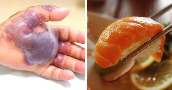 Homem de 71 anos teve braço amputado após comer sushi