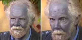 Homem ficou completamente azul depois de tomar “suplementos” por mais de 10 anos
