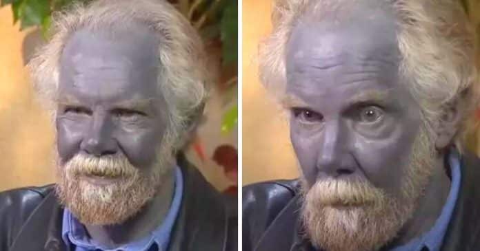 Homem ficou completamente azul depois de tomar “suplementos” por mais de 10 anos