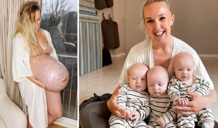 Mãe de trigêmeos revela no Instagram sua barriga antes e depois do parto – “Isso é insano!”