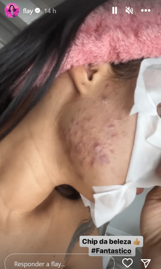 sabiaspalavras.com - Flay choca ao mostrar rea&ccedil;&atilde;o ap&oacute;s usar chip da beleza: 'Efeitos catastr&oacute;ficos'