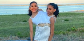 Gêmeas siamesas de 22 anos revelam como é compartilhar um corpo com outra pessoa por mais de duas décadas