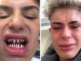 ‘Gastei caro por dentes que deram errado – agora pareço um tubarão em um filme de terror’