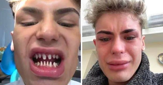 gastei-caro-por-dentes-que-deram-errado-agora-pareco-um-tubarao-em-um-filme-de-terror ‘Gastei caro por dentes que deram errado – agora pareço um tubarão em um filme de terror’