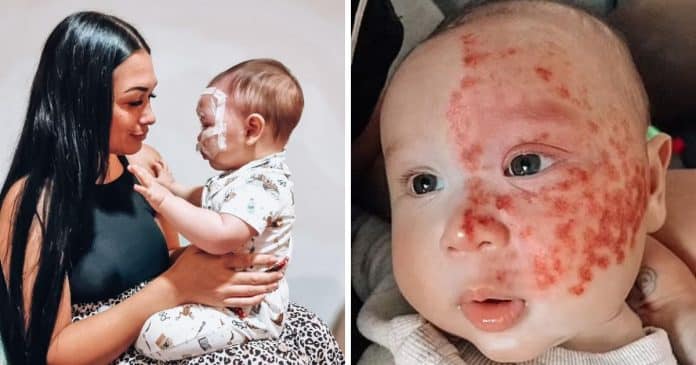 Mãe é chamada de monstro ao aplicar laser em mancha no rosto de bebê