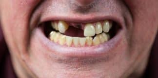 Medicamento inovador poderá gerar o crescimento de novos dentes: ‘O sonho de todo dentista’