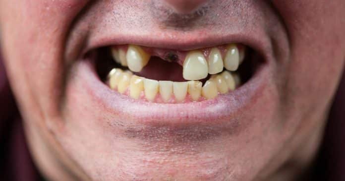 Medicamento inovador poderá gerar o crescimento de novos dentes: ‘O sonho de todo dentista’