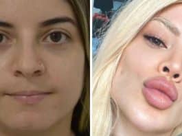 Famosos que fizeram harmonização facial e acabaram por gerar mais polêmica que elogios