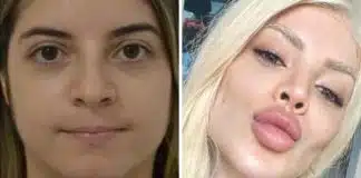 Famosos que fizeram harmonização facial e acabaram por gerar mais polêmica que elogios