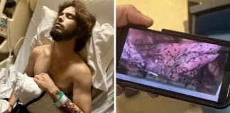 Jovem de 20 anos tem parte do pulmão removido por uso excessivo de “vape”