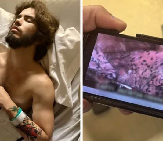 Jovem de 20 anos tem parte do pulmão removido por uso excessivo de “vape”