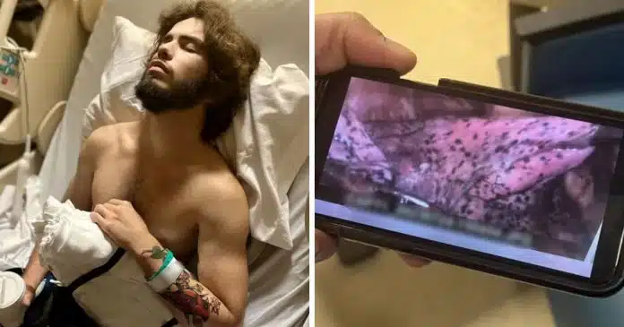 jovem-tem-parte-do-pulmao-removido-por-uso-excessivo-de-vape Jovem de 20 anos tem parte do pulmão removido por uso excessivo de “vape”