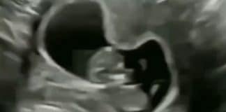 Reação de feto de 10 semanas soluçando dentro da barriga da mãe surpreende internautas