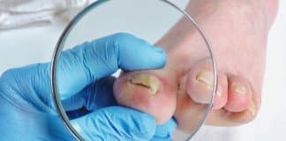 Dermatologistas explicam a causa do fungo nas unhas – e como tratar