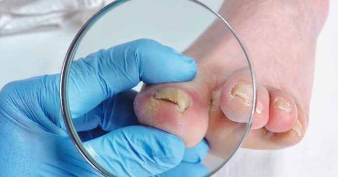 Dermatologistas explicam a causa do fungo nas unhas – e como tratar
