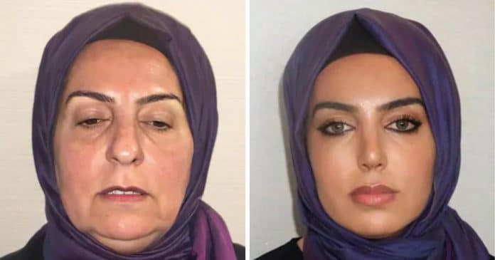 Fotos de antes e depois de cirurgia plástica na Turquia surpreendem a internet