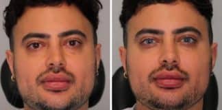Homem muda a cor dos olhos através de procedimento e o resultada impressiona