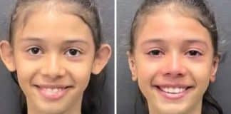 Menina se emociona ao ver resultado da harmonização de orelhas