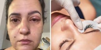 Mulher para em hospital após realizar extensão de cílios
