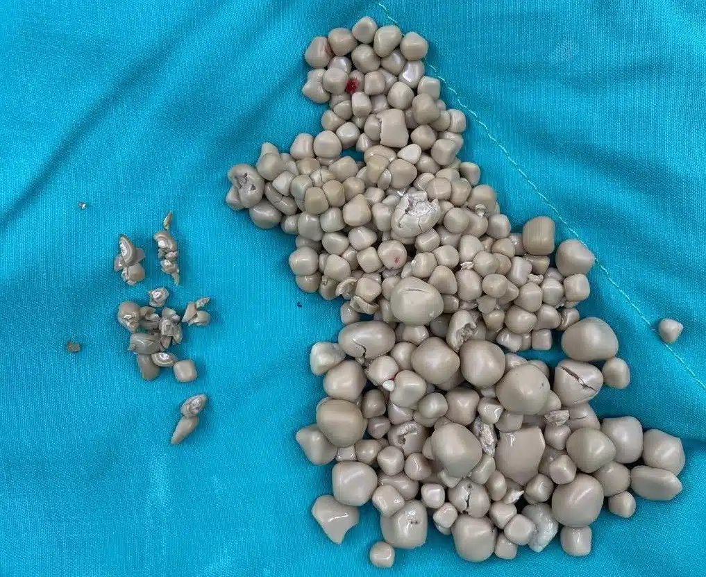 sabiaspalavras.com - Cirurgi&otilde;es retiram mais de 300 pedras no rim de jovem 20 anos que n&atilde;o bebia &aacute;gua