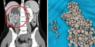 Cirurgiões retiram mais de 300 pedras no rim de jovem 20 anos que não bebia água