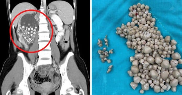 Cirurgiões retiram mais de 300 pedras no rim de jovem 20 anos que não bebia água