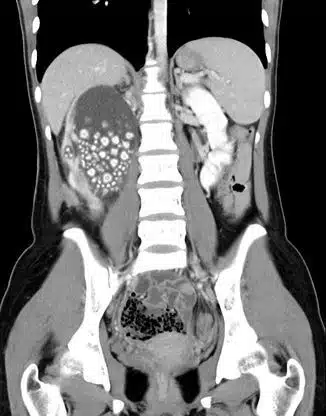 sabiaspalavras.com - Cirurgi&otilde;es retiram mais de 300 pedras no rim de jovem 20 anos que n&atilde;o bebia &aacute;gua