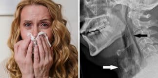 ‘Nunca segure um espirro’: médicos explicam por que isso pode realmente matar você