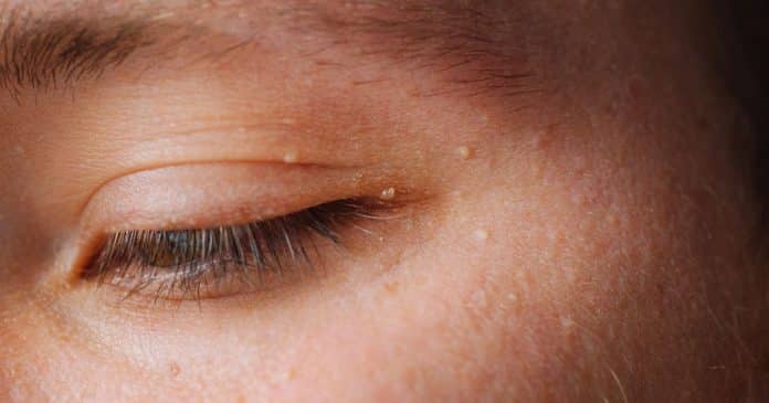 Você tem essas bolinhas brancas no rosto? Saiba como tirar em casa