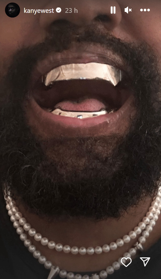 sabiaspalavras.com - Kanye West surpreende ao substituir dentes por dentaduras de tit&acirc;nio de R$4 milh&otilde;es