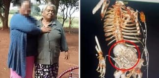 Brasileira de 81 anos morre após cirurgia para remover feto calcificado que ela carregou por 56 anos