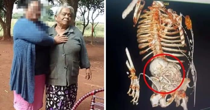 Brasileira de 81 anos morre após cirurgia para remover feto calcificado que ela carregou por 56 anos