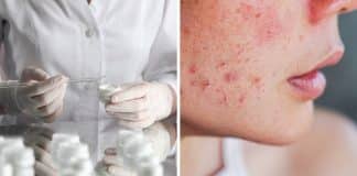 Estas marcas de cremes para acne contêm substâncias químicas ligadas ao câncer; alerta laboratório