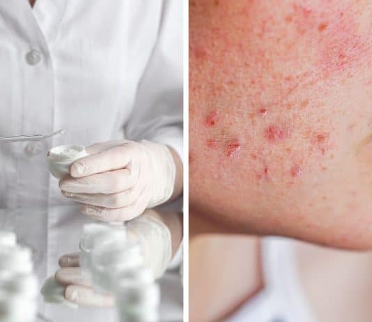 Estas marcas de cremes para acne contêm substâncias químicas ligadas ao câncer; alerta laboratório