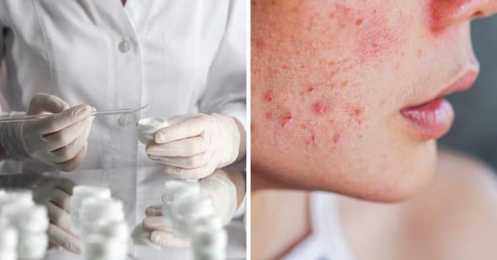 Estas marcas de cremes para acne contêm substâncias químicas ligadas ao câncer; alerta laboratório