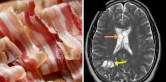 Homem que comia bacon “mal cozido” contrai uma infecção parasitária no cérebro; revelam médicos